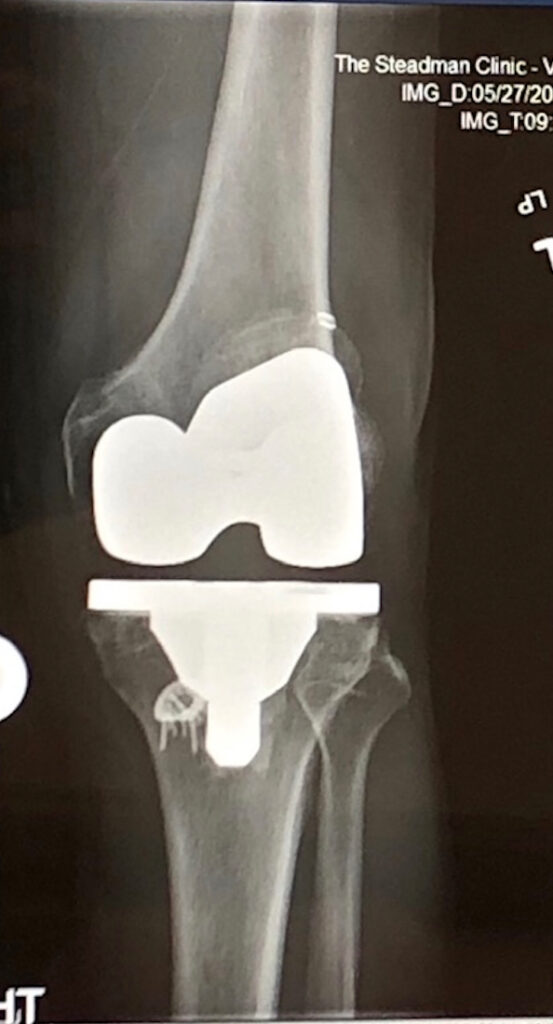 My Bionic Knee