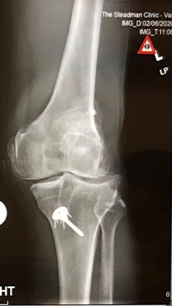 Knee Before Surgery