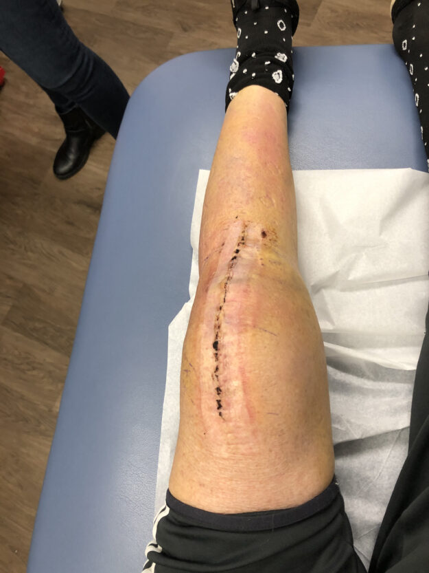 Knee Scar